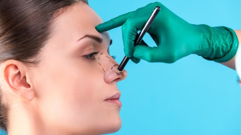 Rhinoplasty